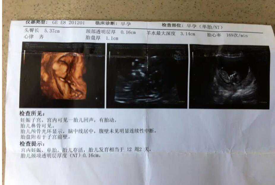 杭州怎样可以助孕 杭州邵逸夫做试管婴儿能否一次成功呢? ‘营口伊人26周四维