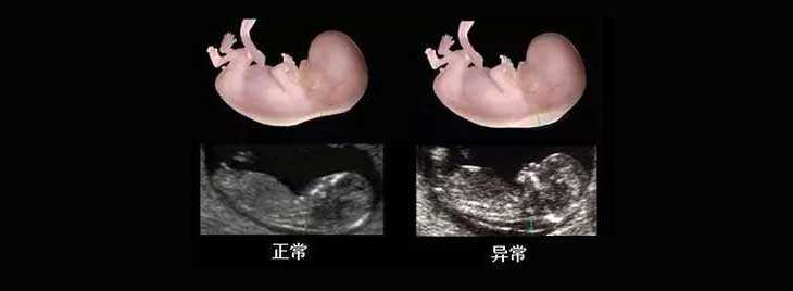试管婴儿可以请人代孕吗_有没有代孕医院_NT检查大揭秘！新竹市做三代试管婴